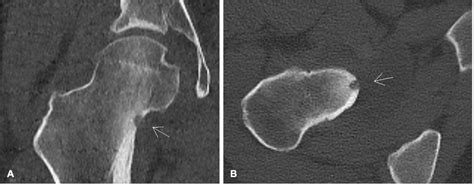 Arthroscopic Excision Of An Intra Articular Osteoid Osteoma On The