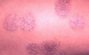 Nummular Eczema - Pictures, Causes, Symptoms, Treatment