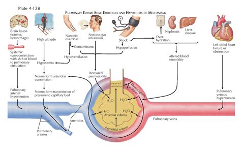 Pulmonary Edema Pediagenosis
