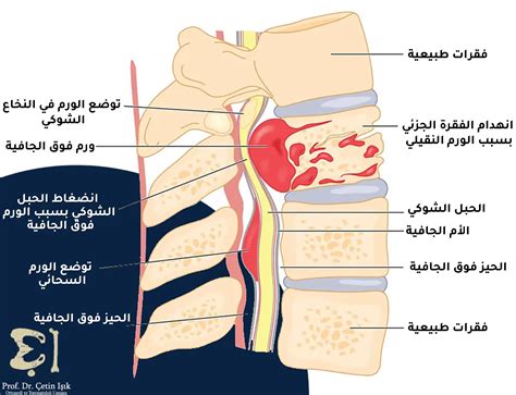 أورام العمود الفقري الحميدة وطرق علاجها الدكتور شتين اشيك