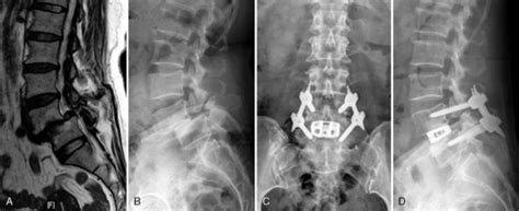 Percutaneous Pedicle Screw Fixation Clinical Gate