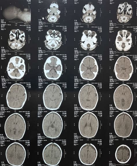 Report Of A Severe Case Of Allan Herndon Dudley Syndrome Genetics And