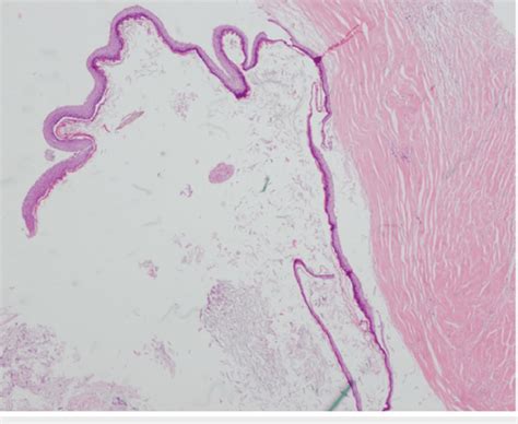 Benign Cyst Lined By Stratified Squamous Epithelium With A Granular