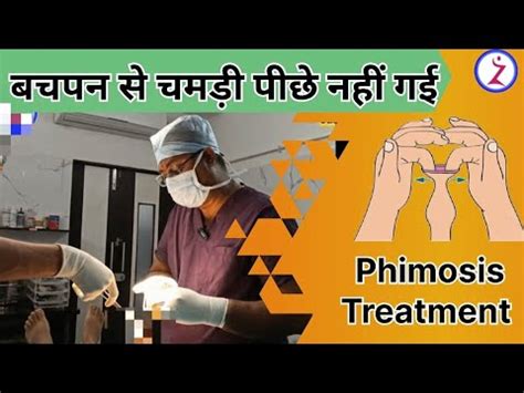 Phimosis Treatment Zsr Circumcision