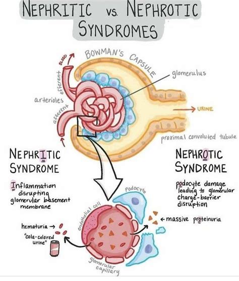 Nephritic Vs Nephrotic Syndrome Medizzy