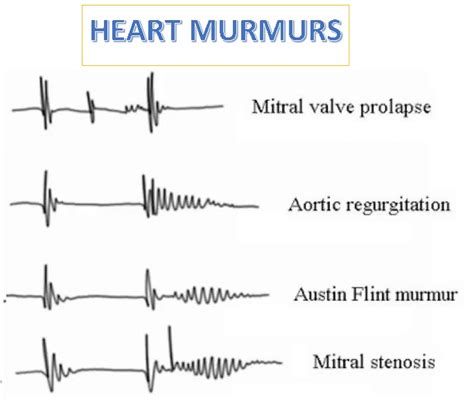 What Is A Heart Murmur Turkey Istanbul Medical