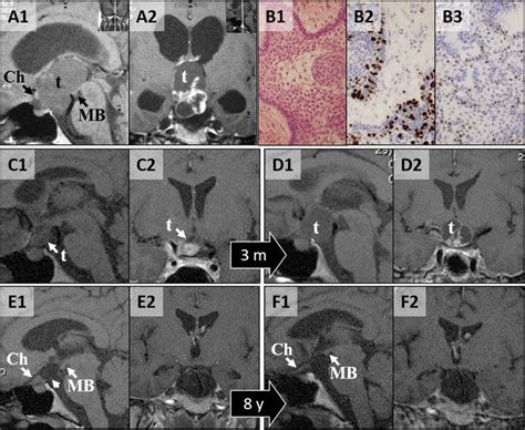 Rapid Recurrence Of An Adamantinomatous CP With High Expression Of