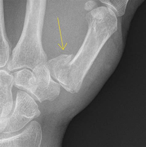 Bennett Fracture Radiology Case Radshare Net