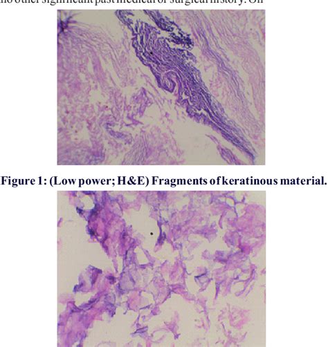 Figure 1 From DIAGNOSTIC IMPORTANCE OF EXTERNAL AUDITORY CANAL