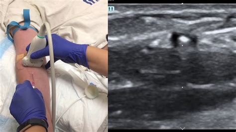 Ultrasound Guided Peripheral IV Short Axis Approach YouTube