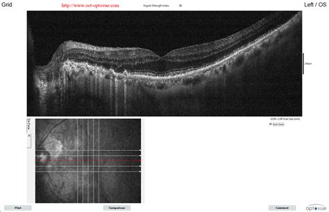 OCT angiography & AMD