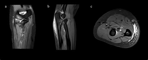 Preoperative Mri Images Of The Right Forearm Mri Sequence