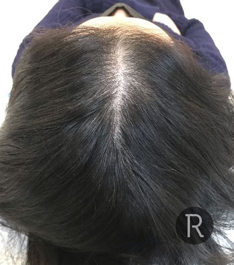 Advanced Prp Hair Treatment London Uk Rejuvence Clinic