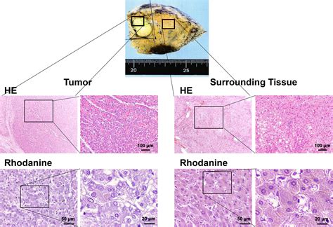 Rare Complication Of Hepatocellular Carcinoma In Wilson S Disease Ohkoshi‐yamada 2021 Jgh