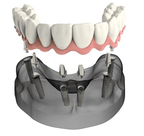 Multiple Dental Implants in Claremont, CA