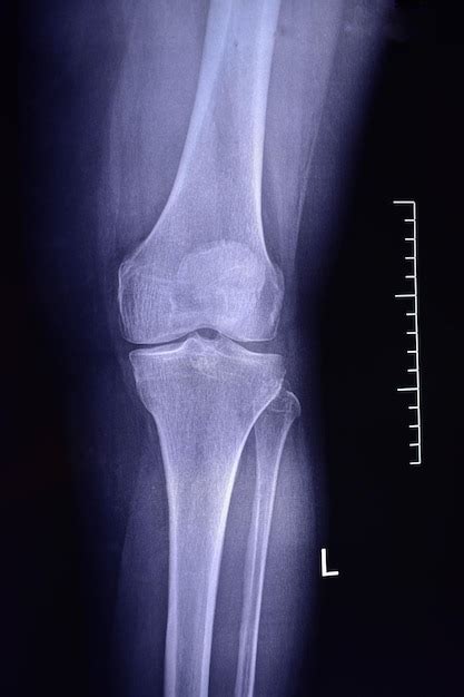 Premium Photo Arthrosis Of The Knee Joint Xray Image