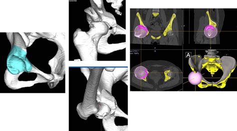 A C Three Dimensional Preoperative Planning With The Zed Hip® Planning Download Scientific