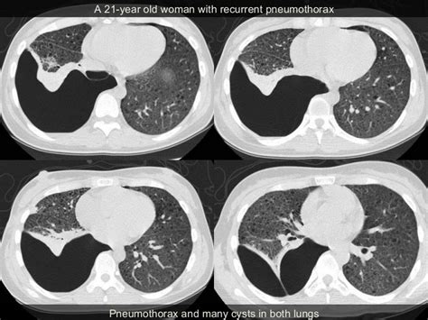 LYMPHANGIOLEIOMYOMATOSIS