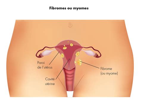 Types De Fibromes Ut Rins