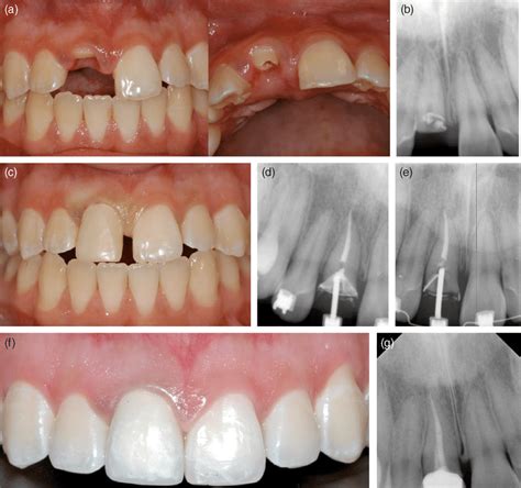 Maxillary Central Incisor Diagram