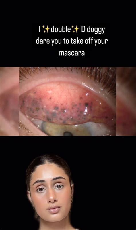 Øyelege sjokkerer ved å vise hva som kan skje med øynene dine hvis du