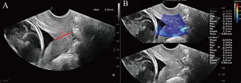 Second Trimester Cervical Shear Wave Elastography Combined With