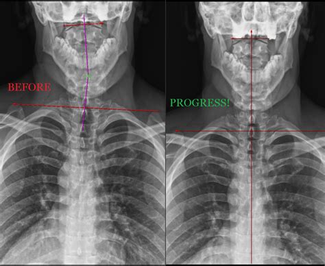 Chiropractic Adjustment Before And After