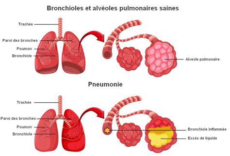 Pneumonie Sympt Mes Fi Vre Contagieuse Ou Pas