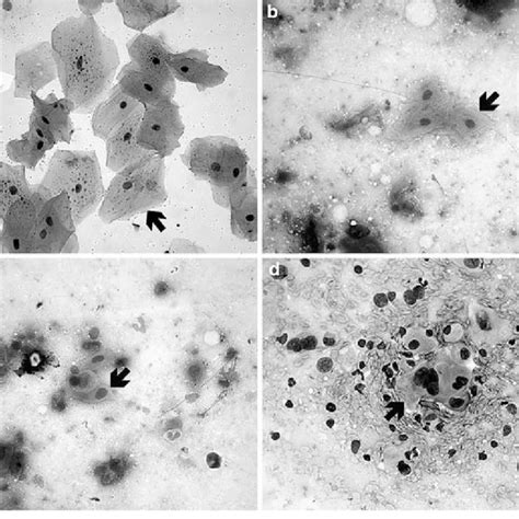 A Keratosis And Hyperplasia Of The Larynx In Touch Smear Cytology