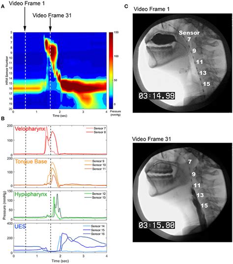 Frontiers Methods For Measuring Swallowing Pressure Variability Using