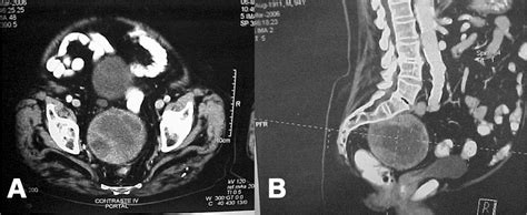 Scielo Brasil Retrorectal Tumor A Case Report Of A Patient With