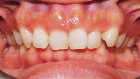 Class Ii Division 2 Malocclusion Deep Bite Excessive Gingival Display Case Gallery