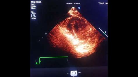 Infective Endocarditisvegetation Youtube