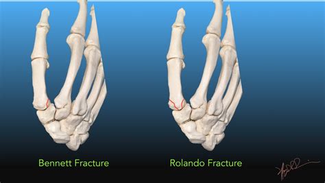 First Metacarpal Base Fractures Uw Emergency Radiology