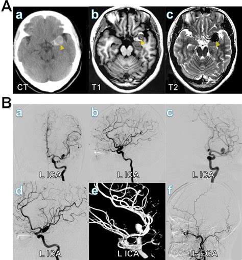 A Preoperative head CT (a) and MRI (b, c) showed a lesion (arrowhead)... | Download Scientific ...