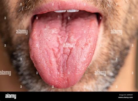 A White Male With Brown And White Facial Hair Tongue Is Sticking Out To Show Geographic Tongue