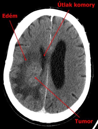 Tumor mozku CT Medicína nemoci studium na 1 LF UK