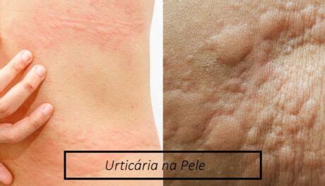 Rem Dio E Pomada Para Urticaria No Corpo Irrita O Na Pele