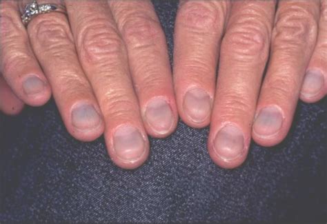 15 Health Warnings Your Fingernails May Be Sending