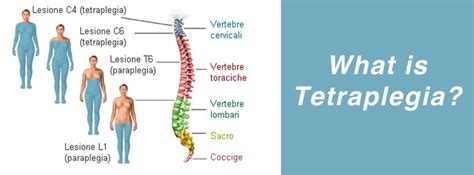 Tetraplegia Symptoms And Treatment Mediologiest