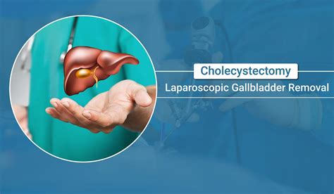 Laparoscopic Gallbladder Removallaparoscopic Gallbladder Removalcholecystectomy Understanding