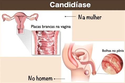 Sinais De Que Voc Pode Estar Candid Ase Genital Fa A O Teste