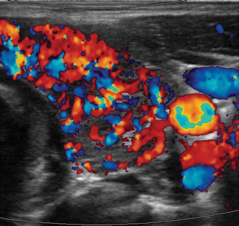 Sonographic Features Of Diffuse Hashimoto Thyroiditis Determining