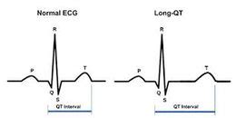 Síndrome de QT largo EcuRed