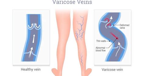 Leg Swelling & Leg Pain In Relation To Varicose Veins | Dr. Peter Mann