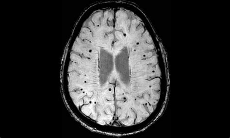 Could MRI scans be used to reduce risk of stroke patients suffering deadly brain bleeds? | UCL ...