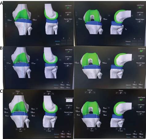 Robotic Arm Assisted Total Knee Arthroplasty In Patients With Flexible