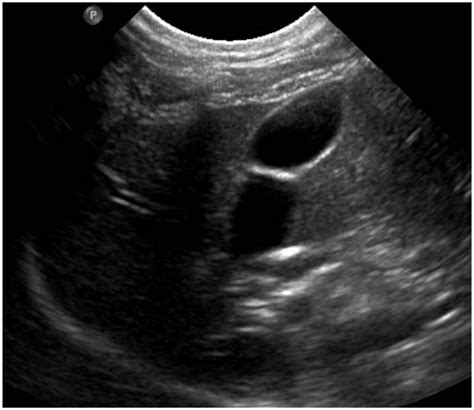 Ultrasonographic Prevalence And Proposed Morphologic Classification Of