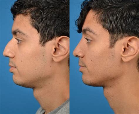 Male Rhinoplasty Photos | Melbourne, FL | Patient 29187