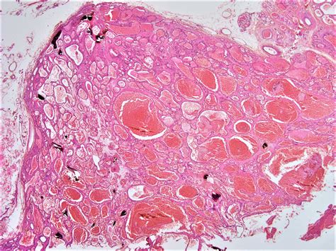 Skin Hemangioma Histology